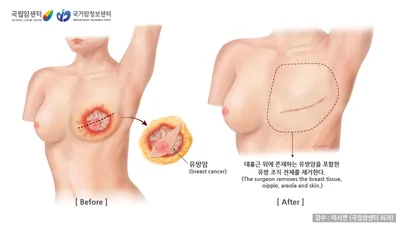유방 전절제술