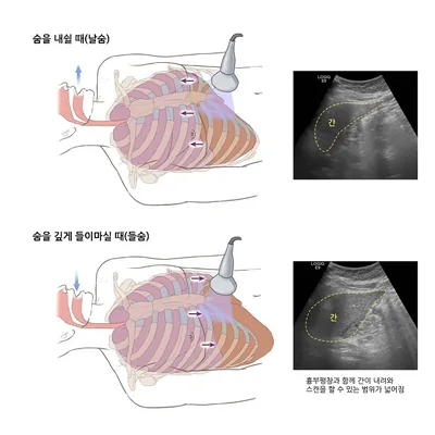 간초음파