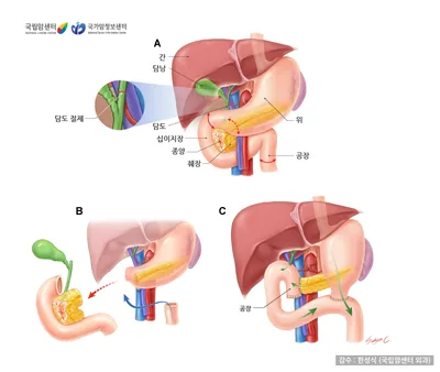휘플씨 수술