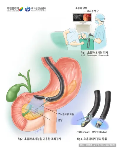 내시경 초음파검사