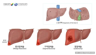 간구역은 크게 8구역으로 나뉘고 절제술은 종양의 진행상황에 따라 종괴절제술, 구역절제술, 엽절제술을 시행할 수 있습니다.