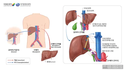 수혜자의 종양이 있는 간을 적출하고 공여자의 간을 이식합니다. 공여자의 간적출 후 남는 혈관과 담도의 끝부분을 봉합합니다. 간이식은 우측간정맥과 중간간정맥을 문합하고, 인조혈관을 이식간의 우측간정맥에 연결하여 수혜자의 하대정맥에 문합, 혈관 및 담도를 문합합니다.