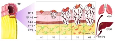 대장암의 병기 - 점막층, 점막하층, 장막, 대장 주위 지방층, 림프절, 1기, 2기, 3기, 4기 : 간, 페, 뇌 등 원격 전이, 절제 불가능한 주위 장기 전이, 애슬러-콜러 병기, A, B1, B2, C1, C2, D
