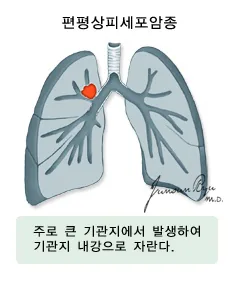 편평상피세포암종 - 주로 큰 기관지에서 발생하여 기관지 내강으로 자란다.